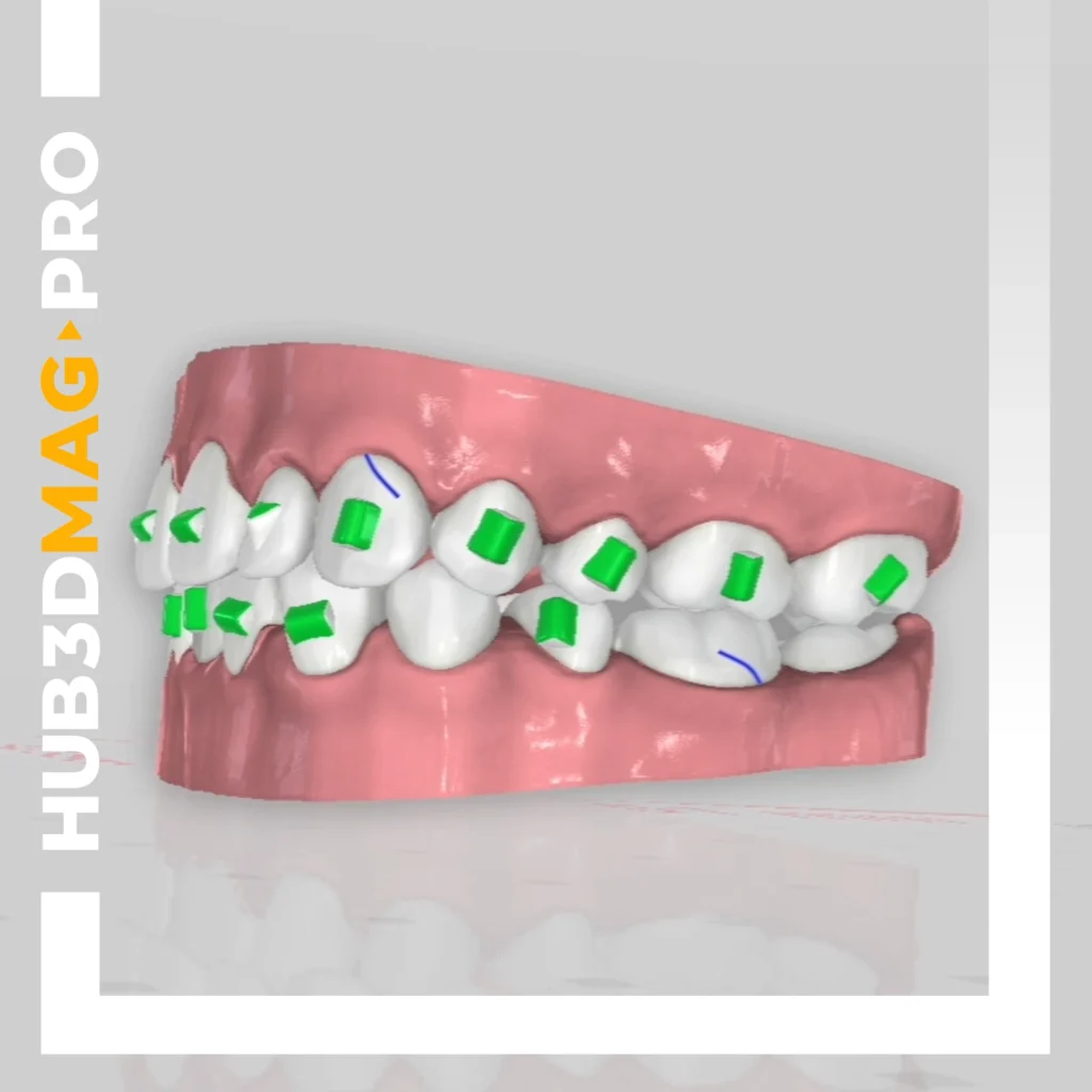 Copertina corso Titan parte 4 HUB3D Orthodontics